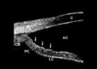 Ultrasound Biomicroscopy 